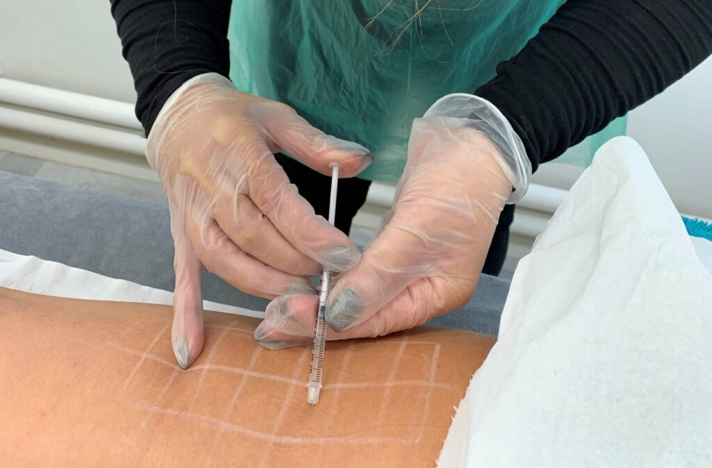 Aqualyx Fat Dissolving Injections