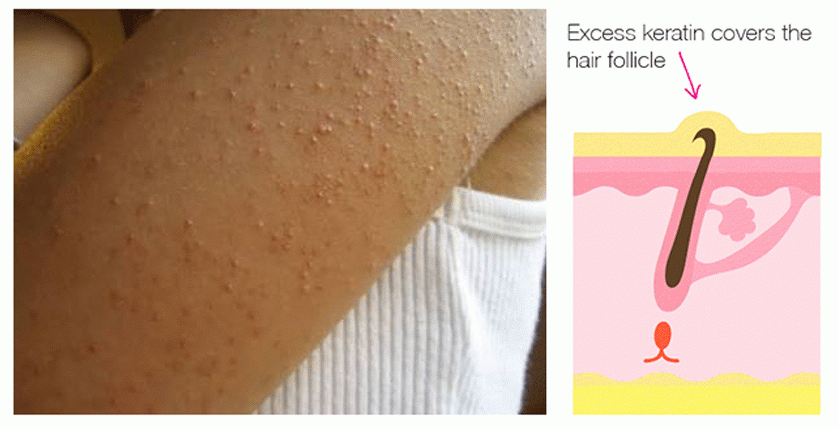 keratosis-pilaris