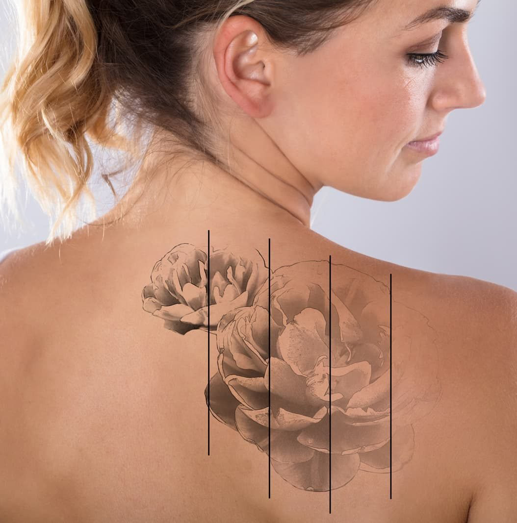 tattoo removal