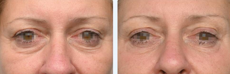 Eye Wrinkle Treatment NZ