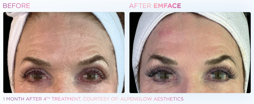 Emface_PIC_Ba-card-female-forehead-069_ENUS100