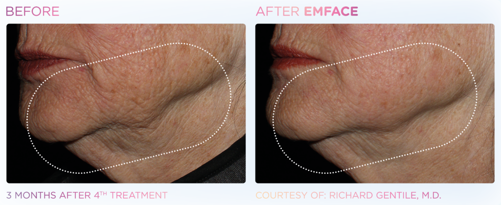 Emface_PIC_Ba-card-female-jawline-042_EN100