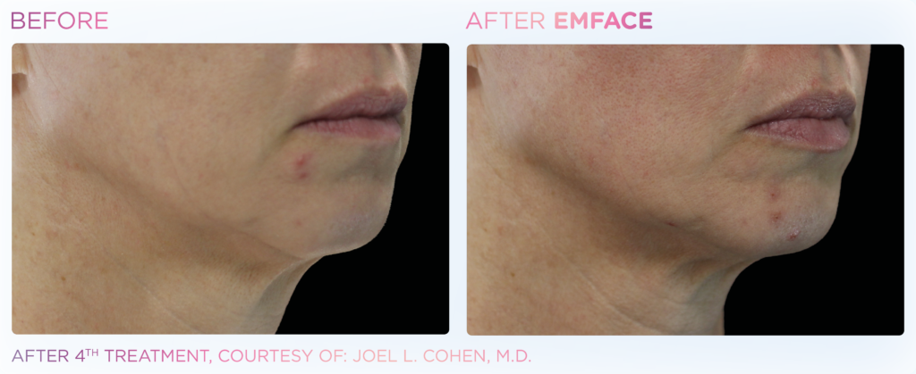 Emface_PIC_Ba-card-female-jawline-059_ENUS100.