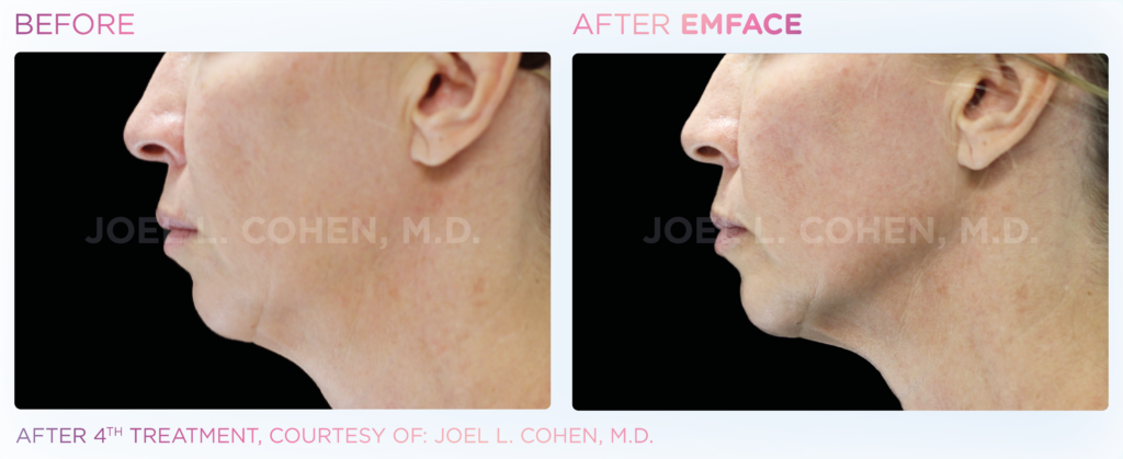 Emface_PIC_Ba-card-female-jawline-060_ENUS100