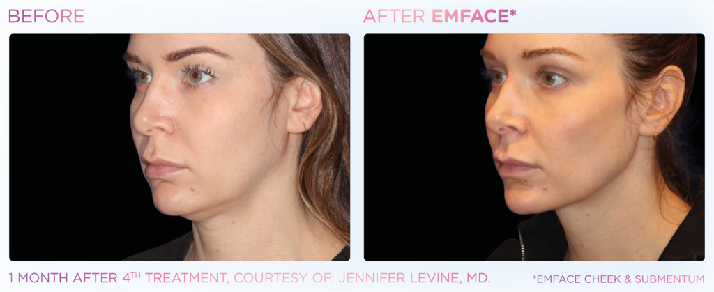 Emface_PIC_Ba-card-female-submentum-124_ENUS100