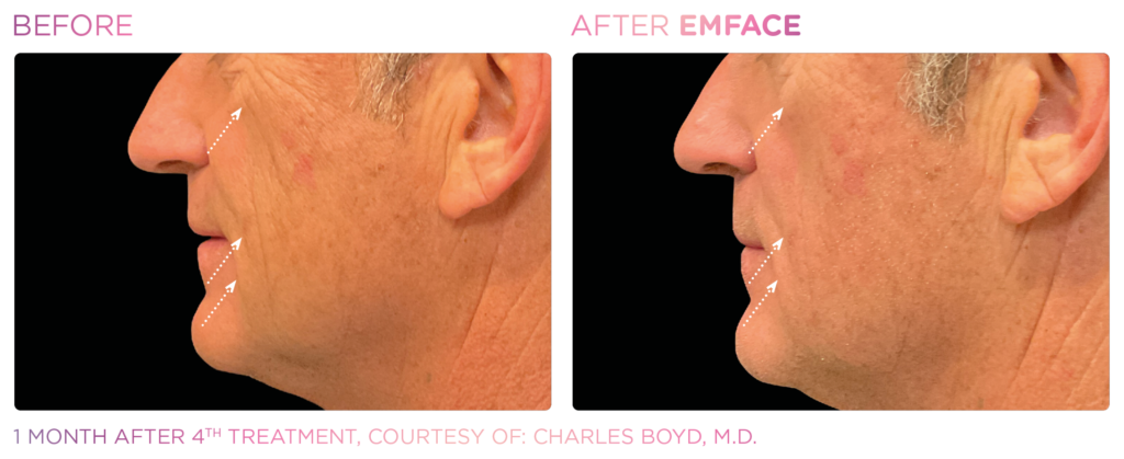 Emface_PIC_Ba-card-male-cheek-047_EN100