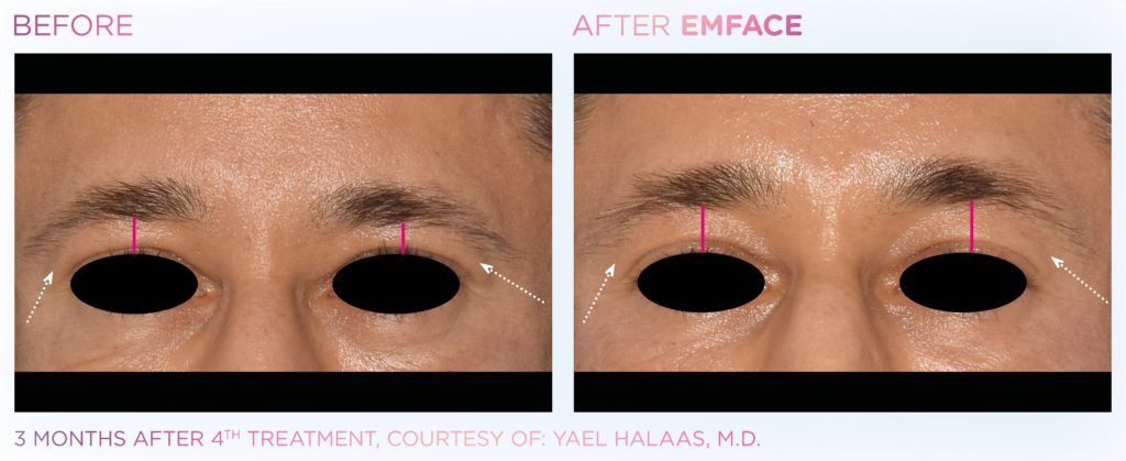 Emface_PIC_Ba-card-male-eyebrows-033_EN100