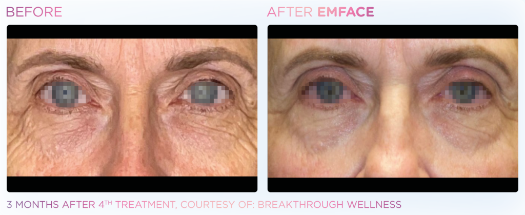 Emface_PIC_Ba-card-male-eyes-103_ENUS