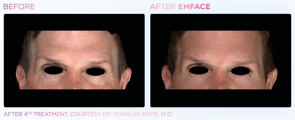 Emface_PIC_Ba-card-male-forehead-055_EN100