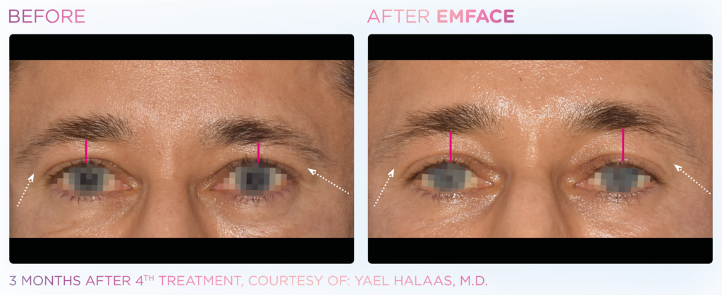 Emface_PIC_Ba-card-male-forhead-033_ENUS