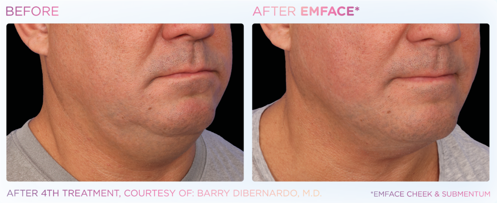 Emface_PIC_Ba-card-male-submentum-115_EN100