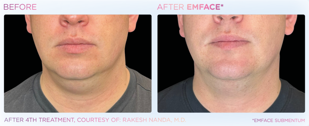 Emface_PIC_Ba-card-male-submentum-125_ENUS100