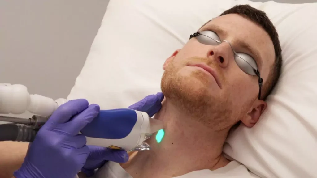 Men Laser Hair Removal NZ