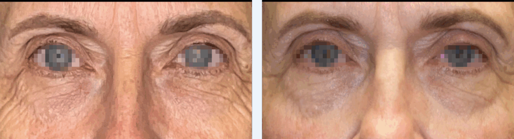 eye bags before and after emface