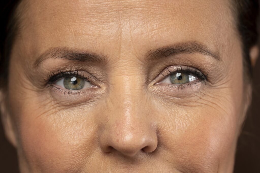 Eye Wrinkle Treatment NZ